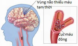 Thiểu năng tuần hoàn não, sát thủ âm thầm gây đột quỵ