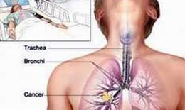 Tìm hiểu về hóa trị liệu