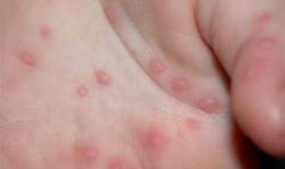 L&#242;ng b&#224;n tay nổi mụn v&#224; ngứa - Chữa trị thế n&#224;o?