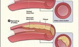 Nhóm thuốc statin điều trị rối loạn mỡ máu