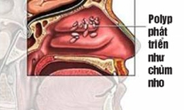 Polyp mũi có nguy hiểm?