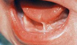 Dính thắng lưỡi ở trẻ