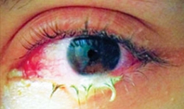 Tổn thương mắt do nấm