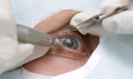 Lão hóa mắt ở người cao tuổi có đáng lo?