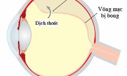 Phát hiện sớm nguy cơ bong võng mạc gây mù