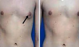 Điều trị thành công ca đàn ông ngực to như phụ nữ