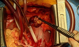 Bệnh nhân mắc u tim kèm hở van động mạch chủ
