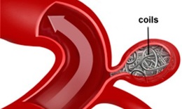 Nút coils cứu sống nữ bệnh nhân vỡ phình mạch não