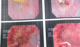 Hóc xương gà, thủng thực quản vì lớn tiếng với con