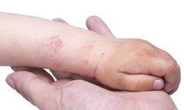 Mẹo giúp trẻ đối phó với bệnh chàm