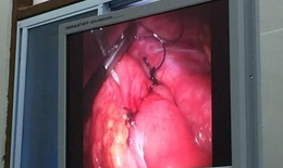 Hà Tĩnh: BV huyện phẫu thuật cắt túi thừa meckel qua nội soi