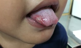 Mắc tay ch&#226;n miệng, b&#233; c&#224;ng đau c&#224;ng dễ biến chứng