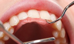 Biến chứng của viêm lợi