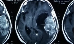Phẫu thuật thành công khối u não “khủng” ở cụ bà 78 tuổi