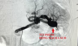 Đau bụng âm ỉ 6 tháng người phụ nữ, phình động mạch lách dọa vỡ