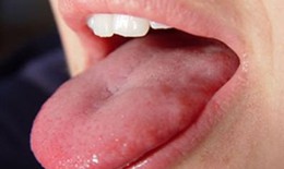 Hạn chế nấm lưỡi