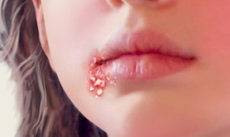 Mắc bệnh lây truyền đường tình dục không do quan hệ