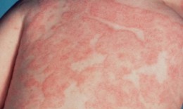 Thế nào là phản ứng dị ứng và các bệnh dị ứng thường gặp