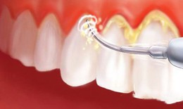 Cao răng phá huỷ sức khỏe răng miệng thế nào?