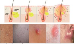 Bất lợi tr&#234;n da khi d&#249;ng corticoid