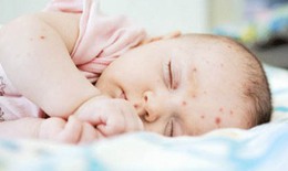 Xuất huyết giảm tiểu cầu ở trẻ có nguy hiểm?