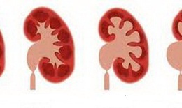 Hẹp phần nối bể thận niệu quản có nguy hiểm?