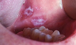 Bệnh răng miệng do thuốc l&#225; g&#226;y ra
