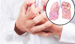 Viêm phế quản thể hen chữa thế nào?