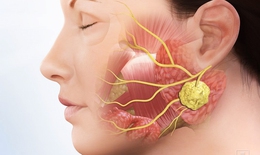 Nhận biết ung thư tuyến nước bọt