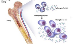 Liệu pháp mới điều trị đa u tủy xương