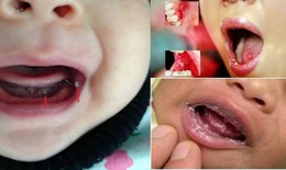 Nhận biết và điều trị nấm miệng