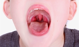 Những nguy cơ gây ung thư vòm họng