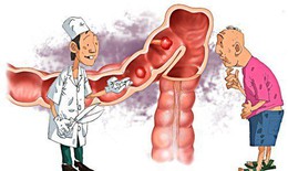 Vi&#234;m đại tr&#224;ng m&#224;ng giả c&#243; nguy hiểm?