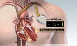 Cải tiến m&#225;y tạo nhịp tim, tăng cơ hội th&#224;nh c&#244;ng khi cấy gh&#233;p