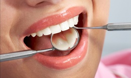 Phát hiện viêm nha chu muộn, nguy cơ mất răng