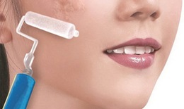 Biện pháp khống chế sẹo lồi