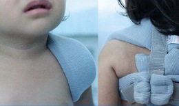 Xử trí gãy xương thường gặp ở trẻ