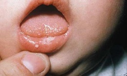 Dùng thuốc trị nấm miệng kéo dài có nguy hiểm cho bé?