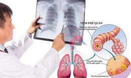 Viêm phế quản diễn biến nặng, tái phát: Đối phó thế nào?