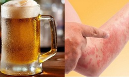 Bia, rượu khiến bệnh dị ứng đa dạng, phức tạp