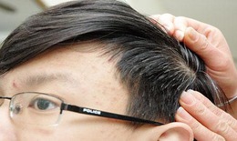 Cách trị tóc bạc sớm