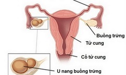 U buồng trứng và ảnh hưởng tới thai nghén