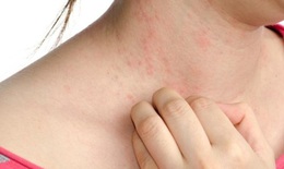 Cẩn trọng chứng viêm da do tiếp xúc cây trồng, ánh sáng