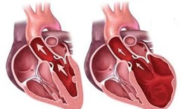 Nhận biết và phòng ngừa bệnh thấp tim