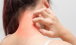 Bệnh mày đay khi trời lạnh: Chủ quan là nguy