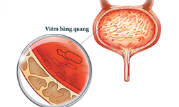 Tiểu nhiều, khi nào là bệnh lý?