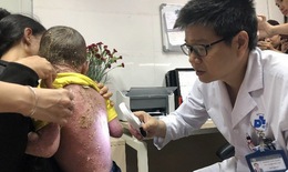 Bệnh vẩy nến dễ tái phát vào mùa khô lạnh