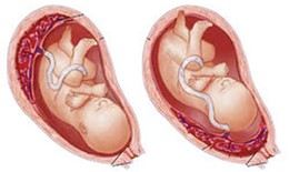 Rau tiền đạo nguy hiểm thế nào?