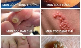 Mụn cóc: Điều trị sớm để tránh lây lan