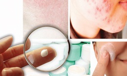 T&#225;c hại của kem trộn chứa corticoid